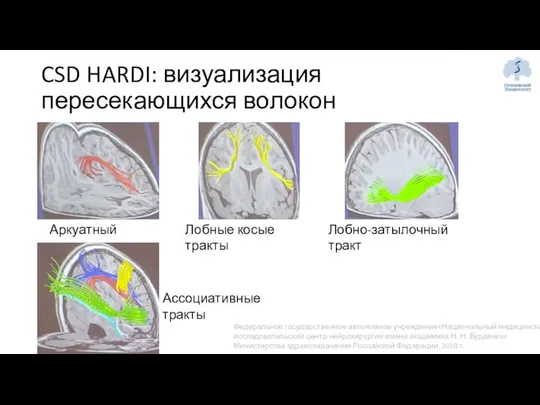 CSD HARDI: визуализация пересекающихся волокон Аркуатный тракт Лобные косые тракты Лобно-затылочный