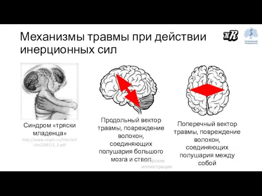 Механизмы травмы при действии инерционных сил Продольный вектор травмы, повреждение волокон,