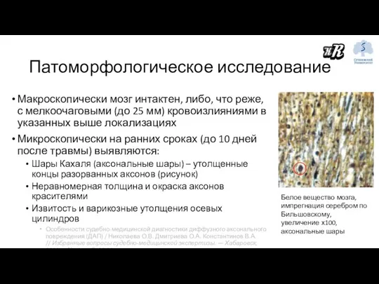 Патоморфологическое исследование Макроскопически мозг интактен, либо, что реже, с мелкоочаговыми (до