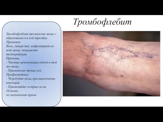Тромбофлебит Тромбофлебит (воспаление вены с образованием в ней тромба). Признаки: Боль,
