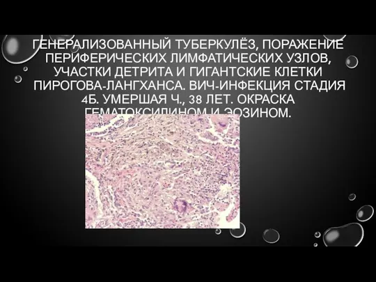 ГЕНЕРАЛИЗОВАННЫЙ ТУБЕРКУЛЁЗ, ПОРАЖЕНИЕ ПЕРИФЕРИЧЕСКИХ ЛИМФАТИЧЕСКИХ УЗЛОВ, УЧАСТКИ ДЕТРИТА И ГИГАНТСКИЕ КЛЕТКИ