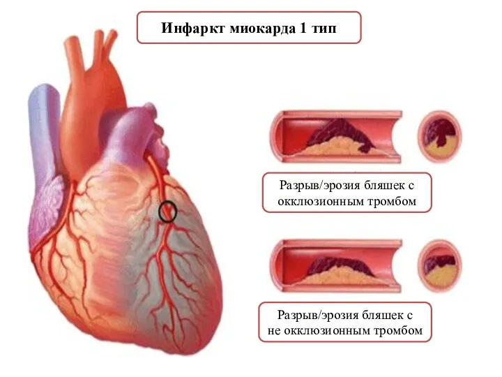 Инфаркт миокарда 1 тип Разрыв/эрозия бляшек с окклюзионным тромбом Разрыв/эрозия бляшек с не окклюзионным тромбом