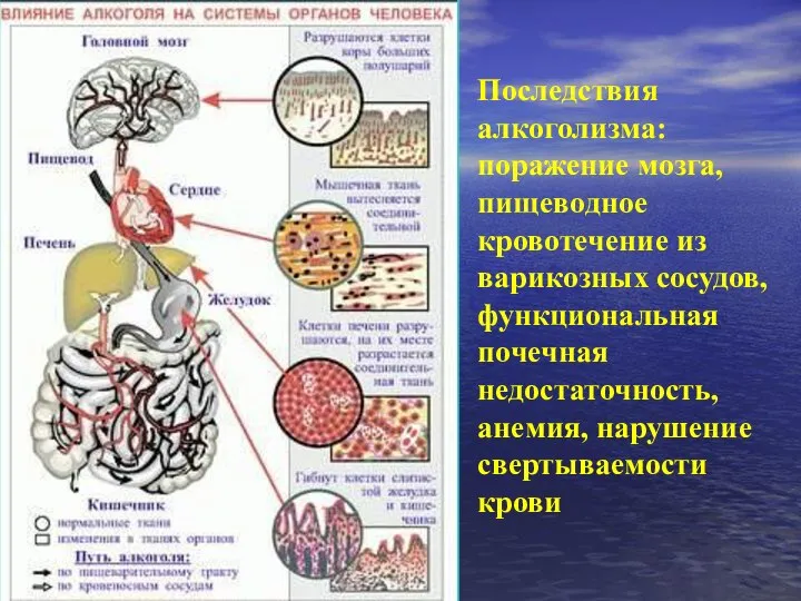 Последствия алкоголизма: поражение мозга, пищеводное кровотечение из варикозных сосудов, функциональная почечная недостаточность, анемия, нарушение свертываемости крови