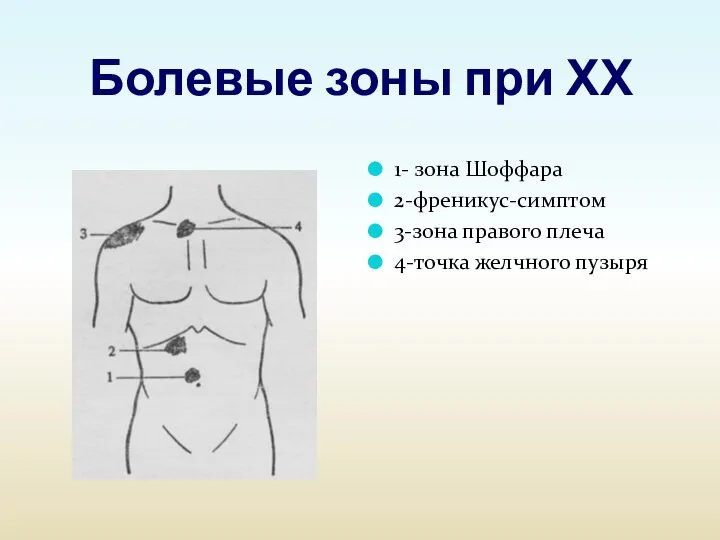 Болевые зоны при ХХ 1- зона Шоффара 2-френикус-симптом 3-зона правого плеча 4-точка желчного пузыря