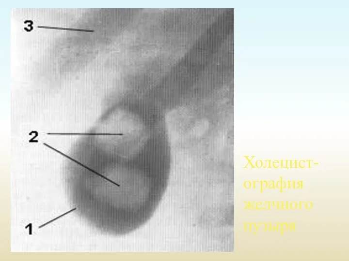 Холецист-ография желчного пузыря