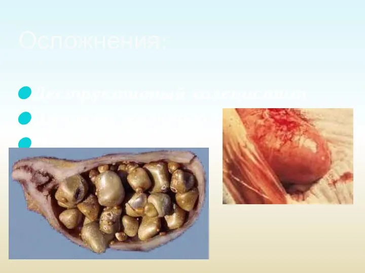 Деструктивный холецистит Эмпиема желчного пузыря Перихолецистит Осложнения: