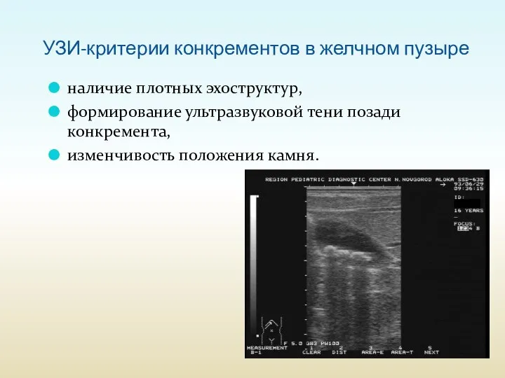 УЗИ-критерии конкрементов в желчном пузыре наличие плотных эхоструктур, формирование ультразвуковой тени позади конкремента, изменчивость положения камня.