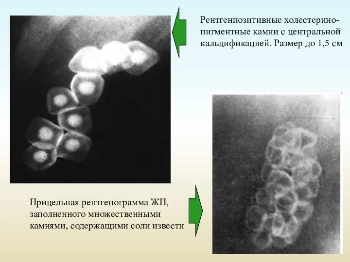 Рентгенпозитивные холестерино-пигментные камни с центральной кальцификацией. Размер до 1,5 см Прицельная