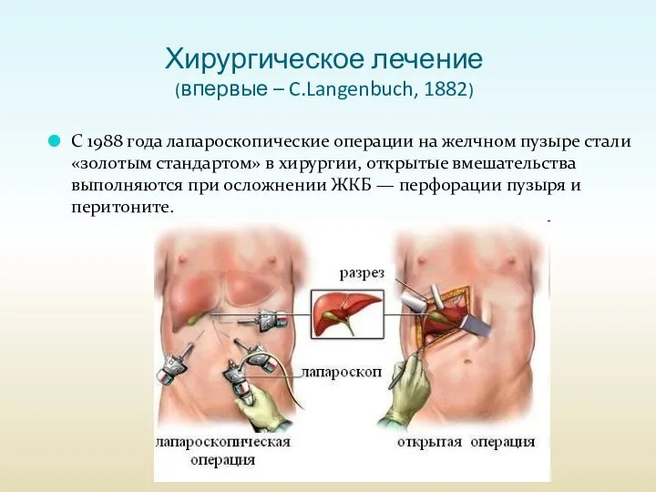 Хирургическое лечение (впервые – C.Langenbuch, 1882) C 1988 года лапароскопические операции