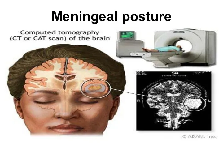 Meningeal posture