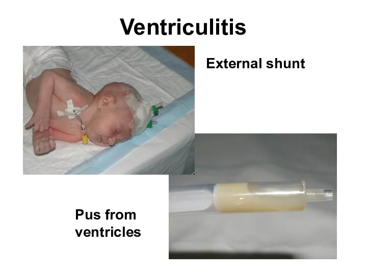 Ventriculitis External shunt Pus from ventricles