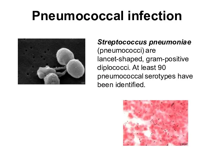 Pneumococcal infection Streptococcus pneumoniae (pneumococci) are lancet-shaped, gram-positive diplococci. At least