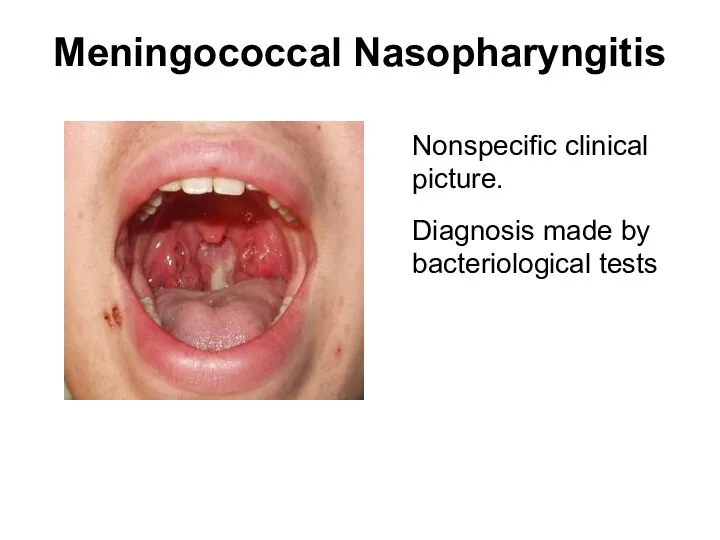 Meningococcal Nasopharyngitis Nonspecific clinical picture. Diagnosis made by bacteriological tests