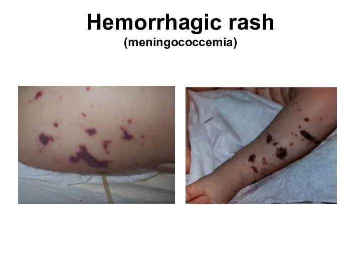 Hemorrhagic rash (meningococcemia)