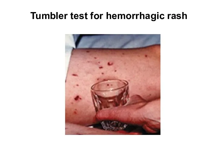 Tumbler test for hemorrhagic rash