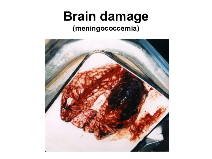 Brain damage (meningococcemia)