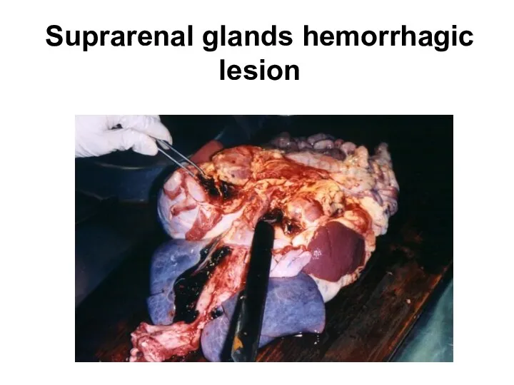 Suprarenal glands hemorrhagic lesion