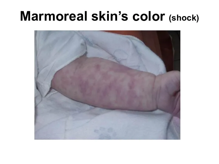 Marmoreal skin’s color (shock)