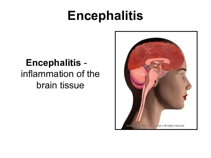 Encephalitis Encephalitis - inflammation of the brain tissue