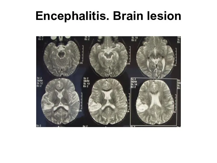Encephalitis. Brain lesion