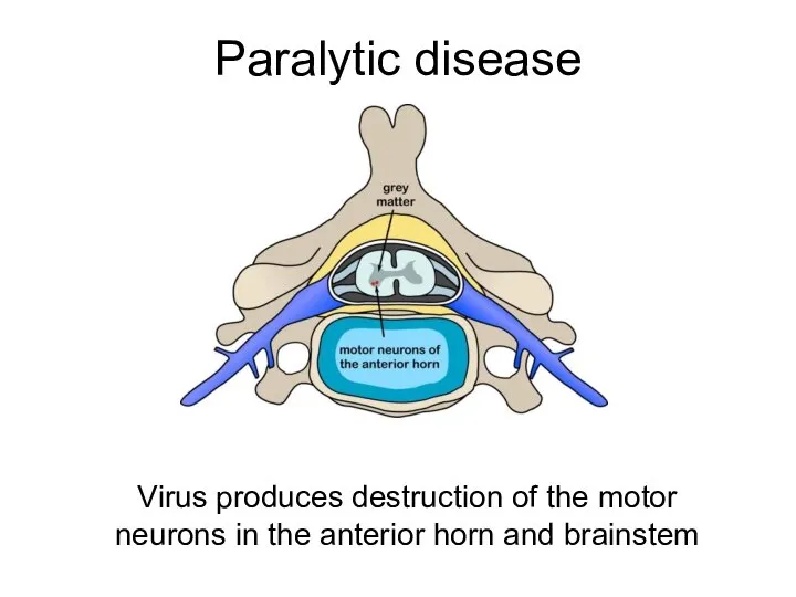 Paralytic disease Virus produces destruction of the motor neurons in the anterior horn and brainstem