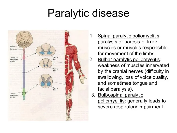 Paralytic disease Spinal paralytic poliomyelitis: paralysis or paresis of trunk muscles