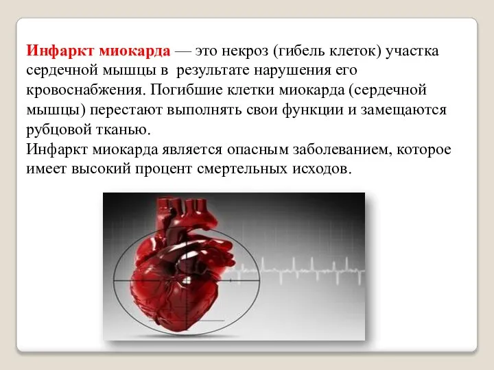 Инфаркт миокарда — это некроз (гибель клеток) участка сердечной мышцы в