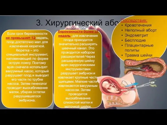 3. Хирургический аборт Если срок беременности не превышает 12 недель, плод