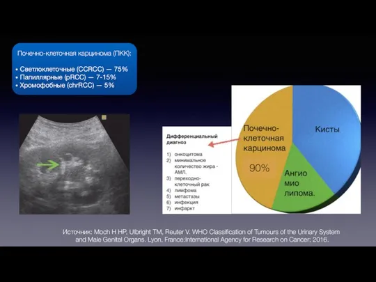 90% Почечно-клеточная карцинома (ПКК): Светлоклеточные (CCRCC) — 75% Папиллярные (pRCC) —