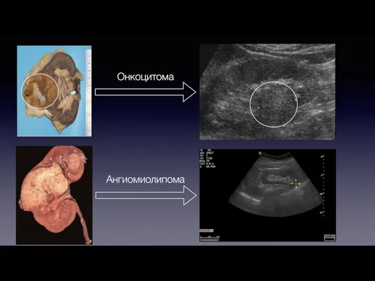 Онкоцитома Ангиомиолипома