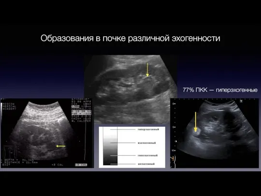 Образования в почке различной эхогенности 77% ПКК — гиперэхогенные