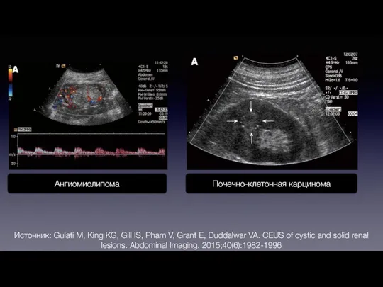 Ангиомиолипома Почечно-клеточная карцинома Источник: Gulati M, King KG, Gill IS, Pham