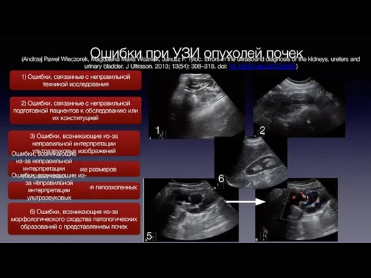 Ошибки при УЗИ опухолей почек 1) Ошибки, связанные с неправильной техникой