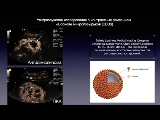 ПКК Ангиомиолипома Ультразвуковое исследование с контрастным усилением на основе микропузырьков (CEUS)