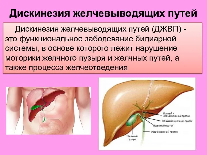 Дискинезия желчевыводящих путей Дискинезия желчевыводящих путей (ДЖВП) - это функциональное заболевание