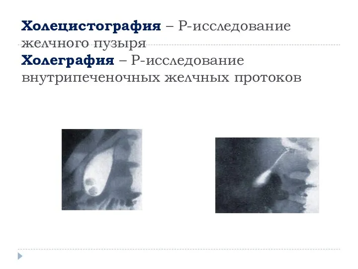 Холецистография – Р-исследование желчного пузыря Холеграфия – Р-исследование внутрипеченочных желчных протоков