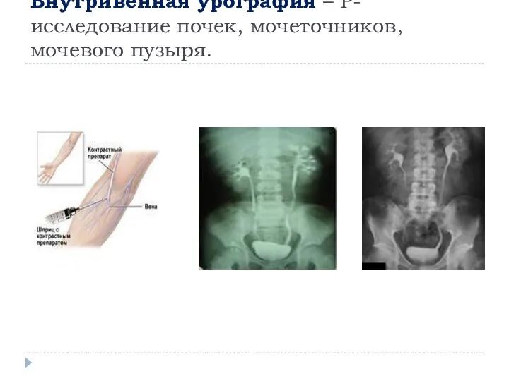 Внутривенная урография – Р-исследование почек, мочеточников, мочевого пузыря.