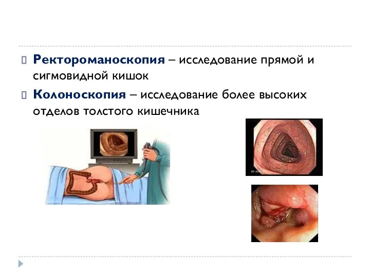 Ректороманоскопия – исследование прямой и сигмовидной кишок Колоноскопия – исследование более высоких отделов толстого кишечника