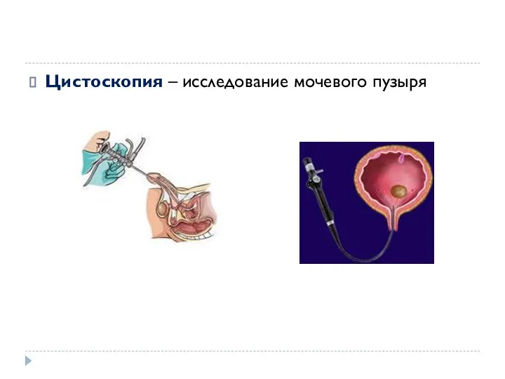 Цистоскопия – исследование мочевого пузыря