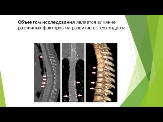 Объектом исследования является влияние различных факторов на развитие остеохондроза