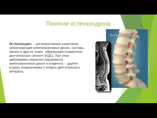 Остеохондроз — дегенеративные изменения, затрагивающие межпозвонковые диски, суставы, связки и другие