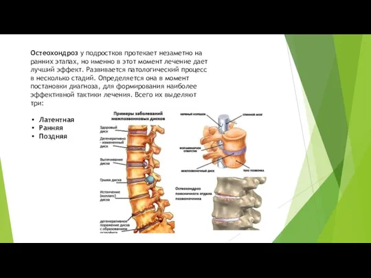 Остеохондроз у подростков протекает незаметно на ранних этапах, но именно в