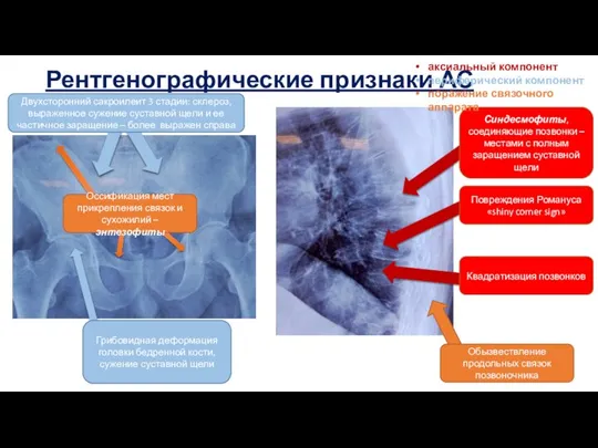 Двухсторонний сакроилеит 3 стадии: склероз, выраженное сужение суставной щели и ее