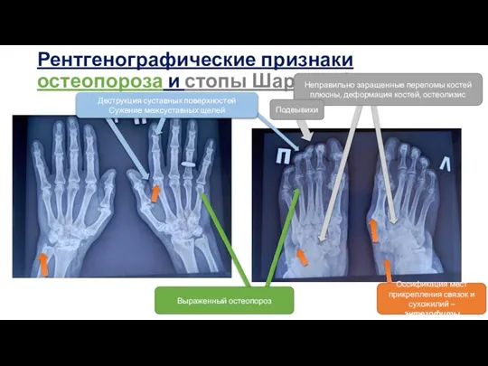 Рентгенографические признаки остеопороза и стопы Шарко и СпА Деструкция суставных поверхностей