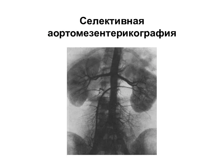 Селективная аортомезентерикография