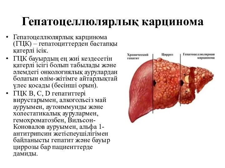 Гепатоцеллюлярлық карцинома Гепатоцеллюлярлық карцинома (ГЦК) – гепатоциттерден бастапқы қатерлі ісік. ГЦК