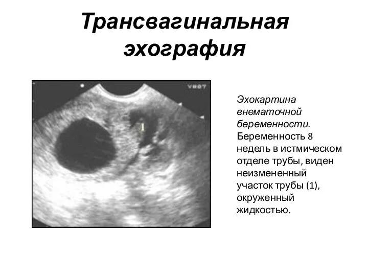 Трансвагинальная эхография Эхокартина внематочной беременности. Беременность 8 недель в истмическом отделе