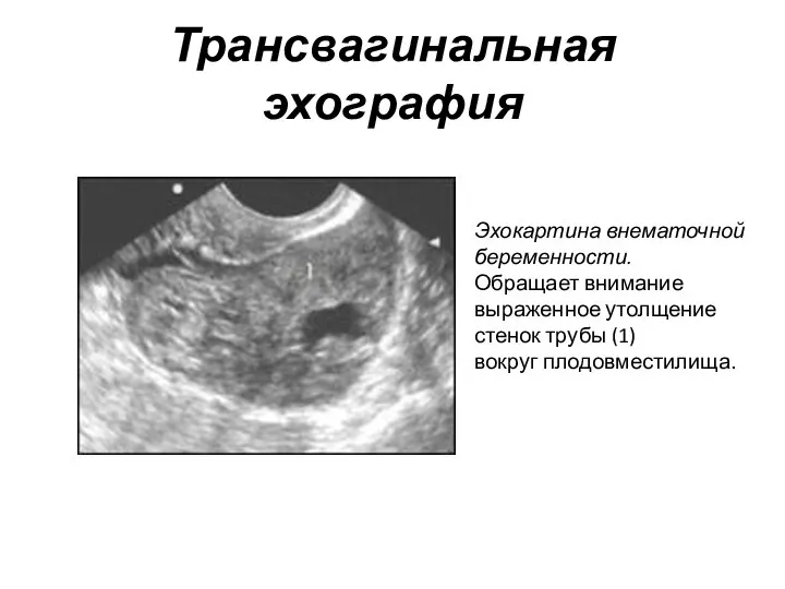 Трансвагинальная эхография Эхокартина внематочной беременности. Обращает внимание выраженное утолщение стенок трубы (1) вокруг плодовместилища.