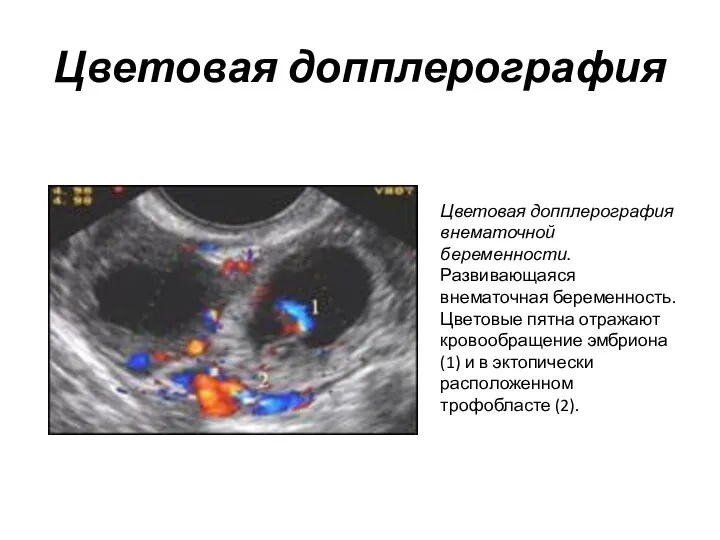 Цветовая допплерография Цветовая допплерография внематочной беременности. Развивающаяся внематочная беременность. Цветовые пятна