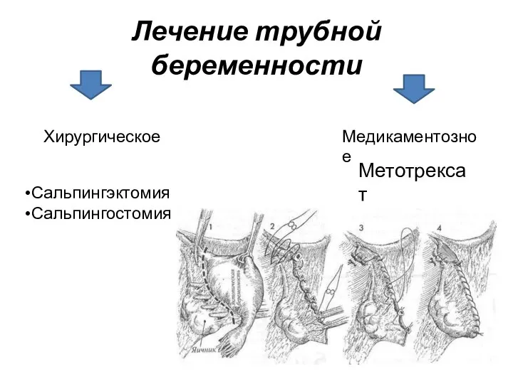 Лечение трубной беременности Хирургическое Медикаментозное Сальпингэктомия Сальпингостомия Метотрексат